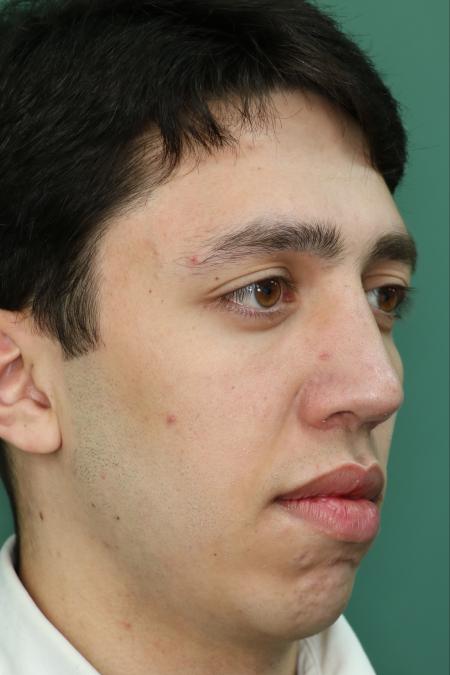 After image 2 Case #126756 - Nasal Deviation Syndrome