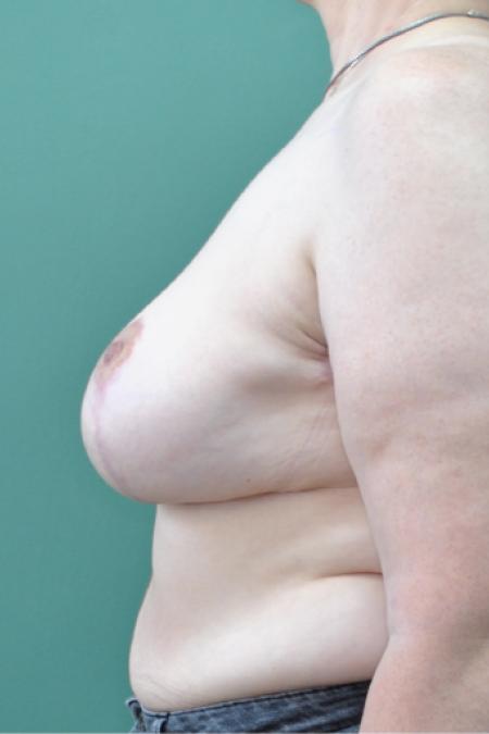 After image 5 Case #126806 - Breast Ptosis