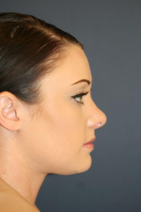 After image 3 Case #126241 - Female Rhinoplasty
