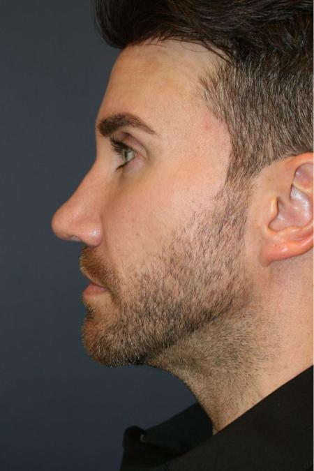 After image 3 Case #126816 - Male Rhinoplasty