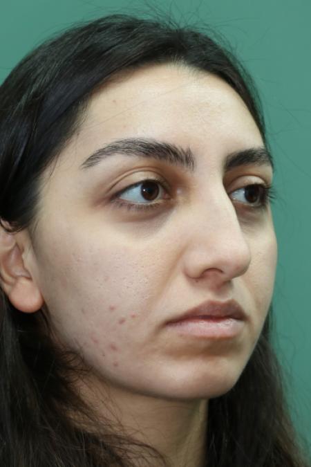 Before image 3 Case #126796 - Nasal Deviation Syndrome. Rhinogenic Headache 