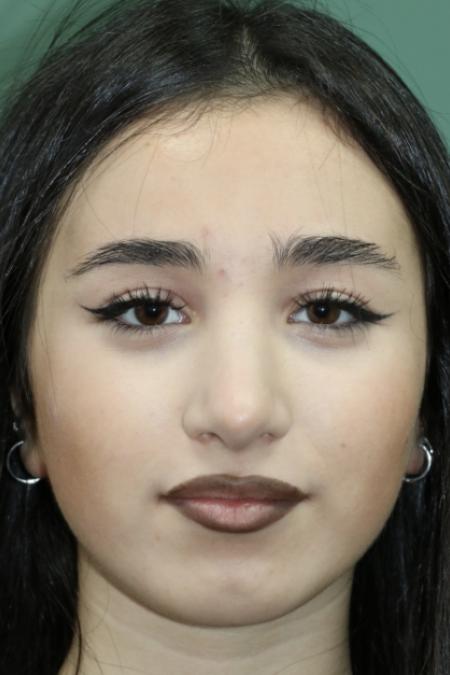 After image 1 Case #126786 - Nasal Deviation Syndrome