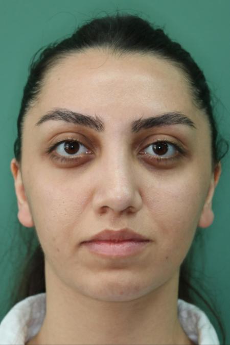 After image 1 Case #126796 - Nasal Deviation Syndrome. Rhinogenic Headache 