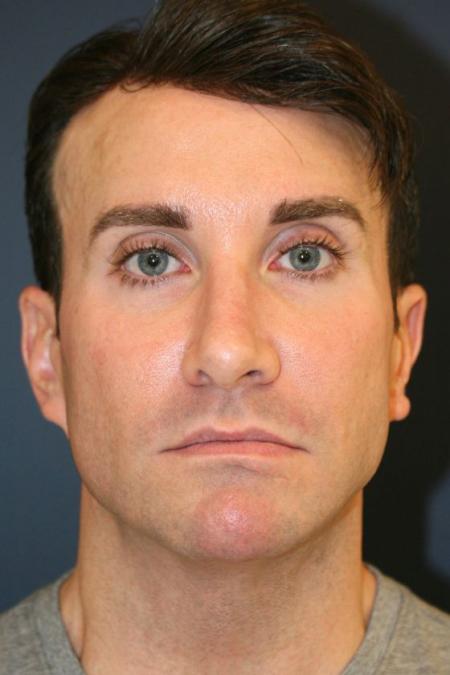 Before image 1 Case #126816 - Male Rhinoplasty