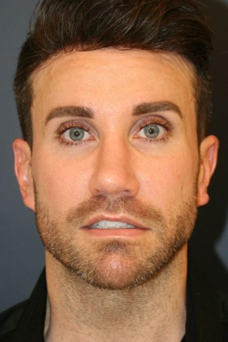 After image 1 Case #126816 - Male Rhinoplasty