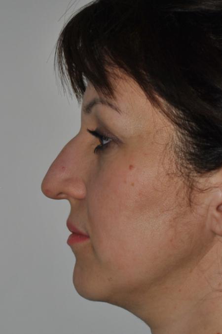 Before image 5 Case #126781 - Aesthetic Reduction Rhinoplasty