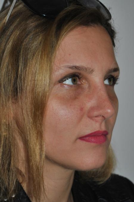 After image 3 Case #126766 - Nasal Deviation Syndrome