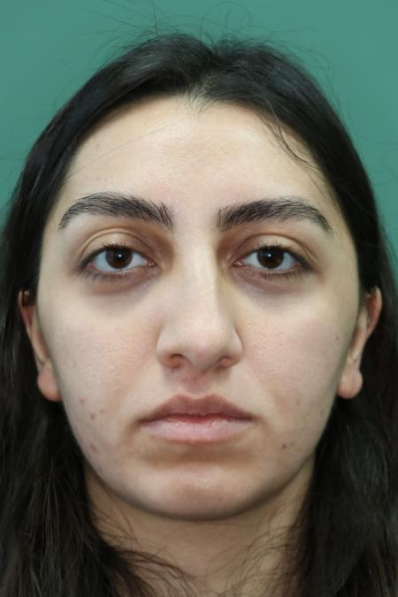 Before image 1 Case #126796 - Nasal Deviation Syndrome. Rhinogenic Headache 