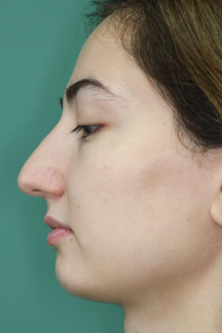Before image 4 Case #126811 - Reduction Rhinoplasty