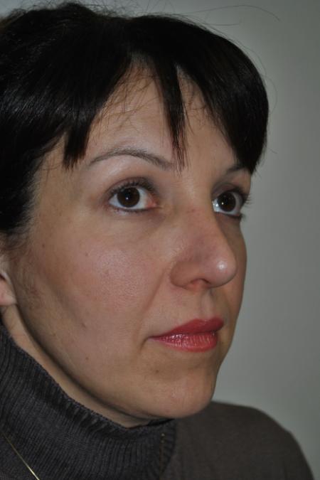 After image 2 Case #126781 - Aesthetic Reduction Rhinoplasty