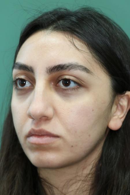 Before image 2 Case #126796 - Nasal Deviation Syndrome. Rhinogenic Headache 