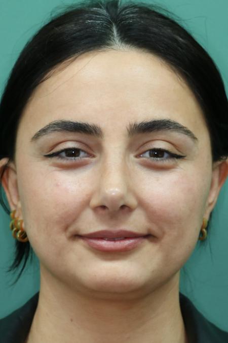 After image 1 Case #122581 - Primary Rhinoplasty