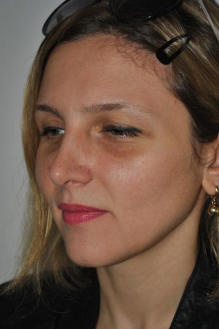 After image 2 Case #126766 - Nasal Deviation Syndrome