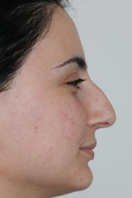 Before image 4 Case #122581 - Primary Rhinoplasty