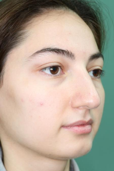 Before image 2 Case #126811 - Reduction Rhinoplasty