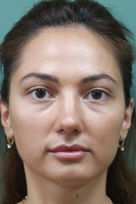 After image 1 Case #126811 - Reduction Rhinoplasty