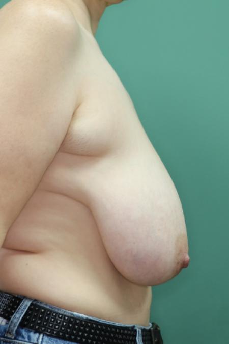 Before image 4 Case #126806 - Breast Ptosis