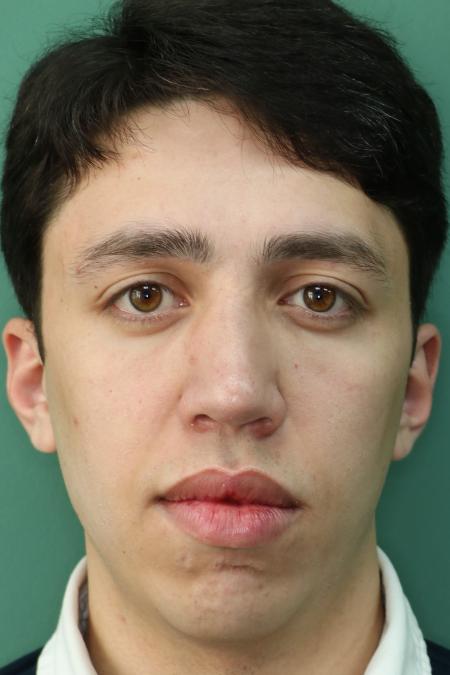 After image 1 Case #126756 - Nasal Deviation Syndrome