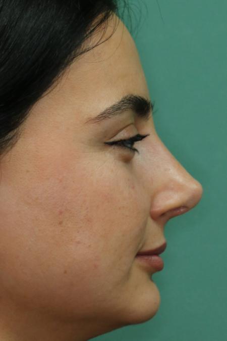 After image 4 Case #122581 - Primary Rhinoplasty