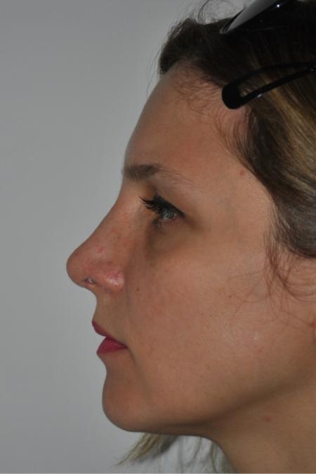 After image 5 Case #126766 - Nasal Deviation Syndrome