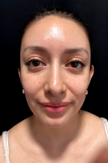 After image 1 Case #127526 - Septoplasty