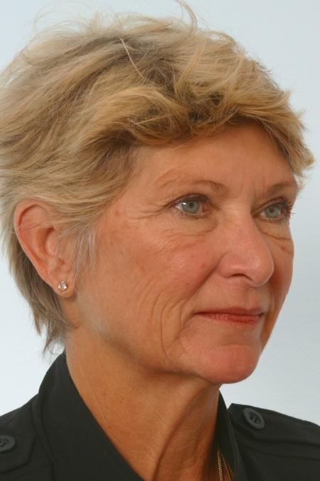 Before image 2 Case #127156 - Facelift