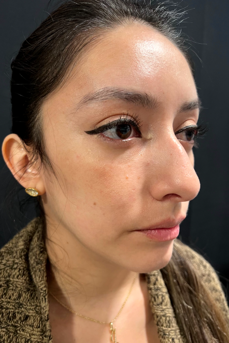 Before image 2 Case #127526 - Septoplasty