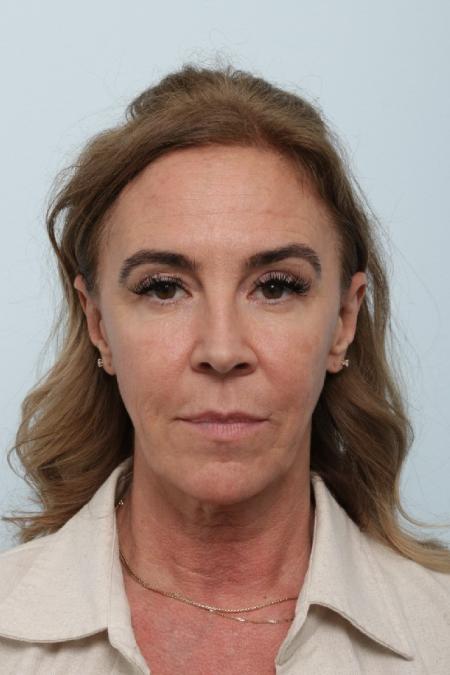 Before image 1 Case #127056 - Facelift
