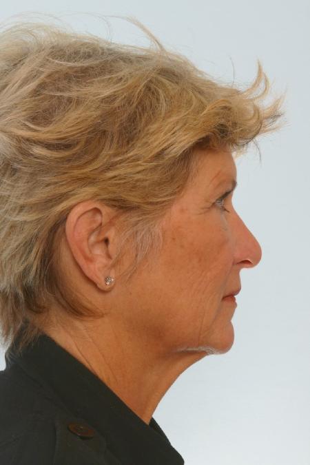 Before image 3 Case #127156 - Facelift