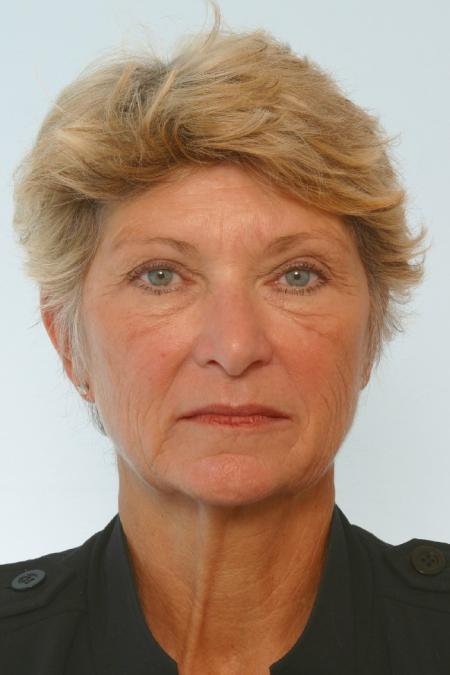 Before image 1 Case #127156 - Facelift