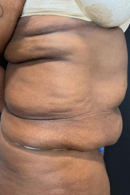 Before image 3 Case #127501 - Abdominoplasty