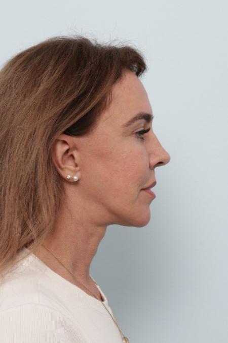 After image 3 Case #127056 - Facelift