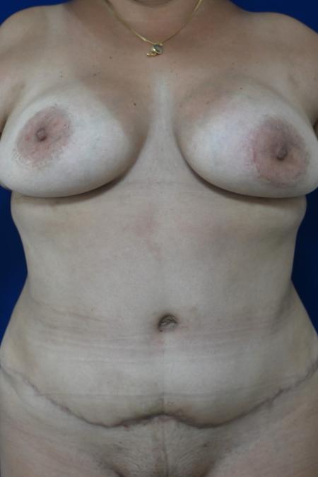 After image 1 Case #127131 - Case 3 - Lipoabdominoplasty & Breast Implants