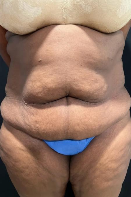 Before image 1 Case #127501 - Abdominoplasty