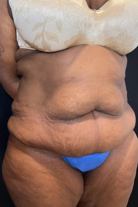 Before image 2 Case #127501 - Abdominoplasty