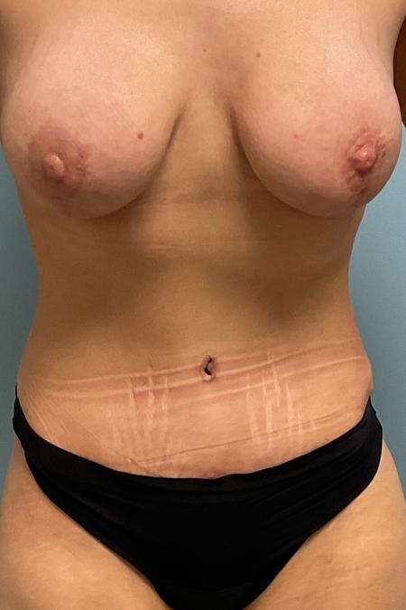After image 1 Case #126956 - 38 year old female Breast Lift with Abdominoplasty
