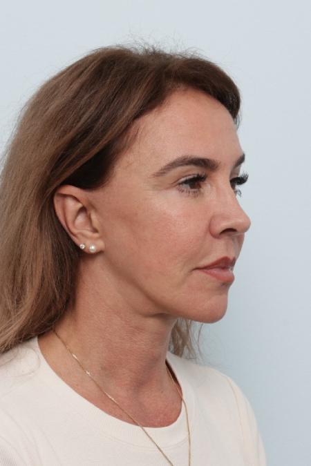 After image 2 Case #127056 - Facelift