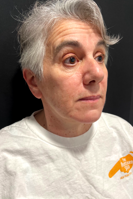 After image 2 Case #127521 - Neck Lift