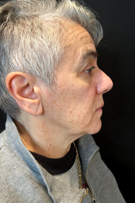 Before image 3 Case #127521 - Neck Lift