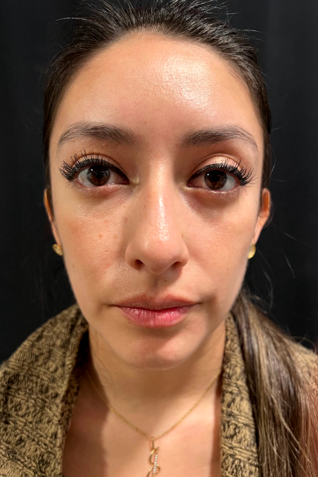 Before image 1 Case #127526 - Septoplasty