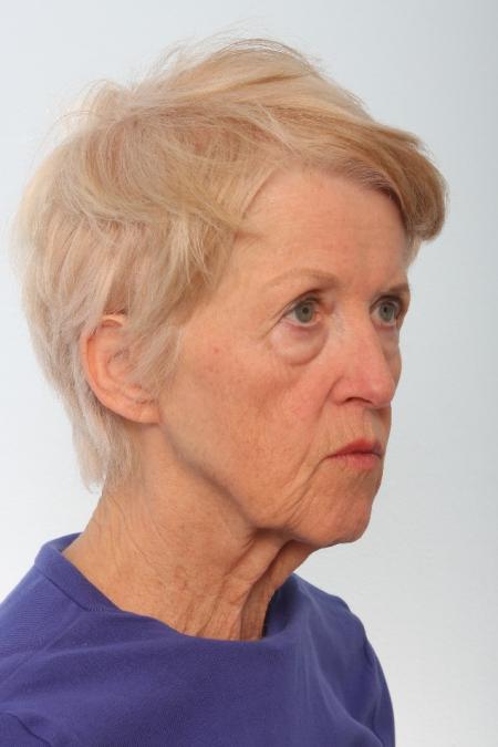 Before image 2 Case #127061 - Facelift