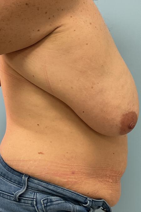 Before image 2 Case #126986 - 44 year old female Breast Reduction w/ Lipo