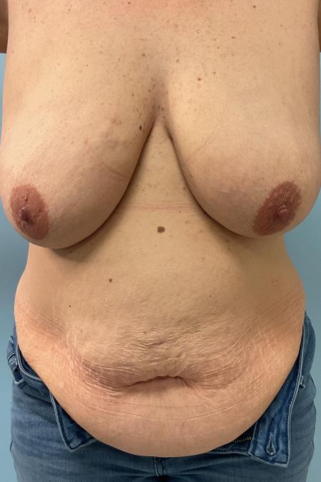 Before image 1 Case #126986 - 44 year old female Breast Reduction w/ Lipo