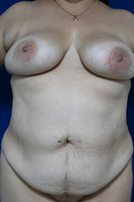 Before image 1 Case #127131 - Case 3 - Lipoabdominoplasty & Breast Implants