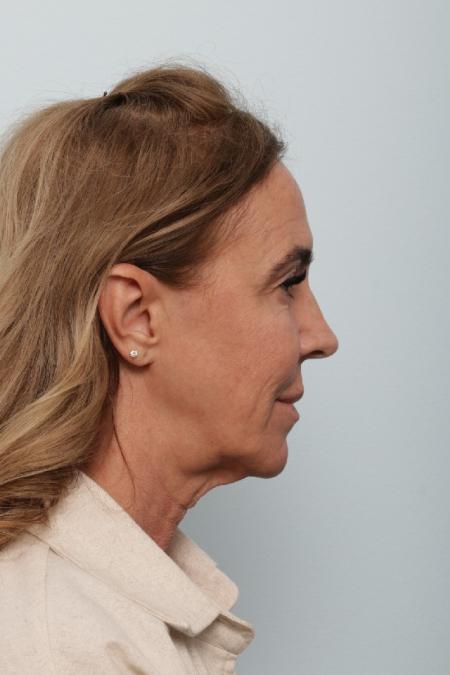 Before image 3 Case #127056 - Facelift