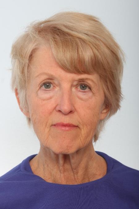 Before image 1 Case #127061 - Facelift