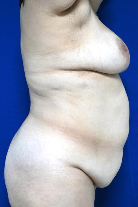 Before image 3 Case #127131 - Case 3 - Lipoabdominoplasty & Breast Implants