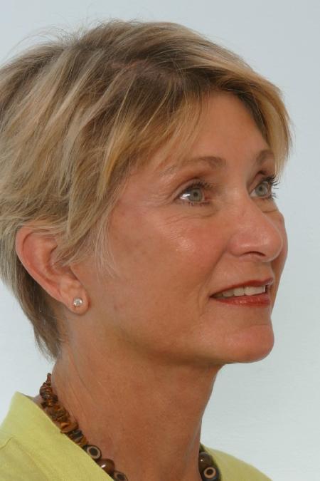 After image 2 Case #127156 - Facelift