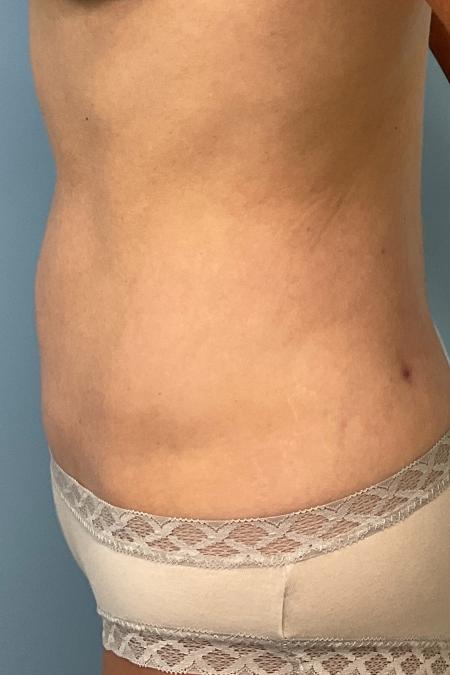 After image 3 Case #126926 - a 47 year old female; mini tummy tuck w/ lipo 360 