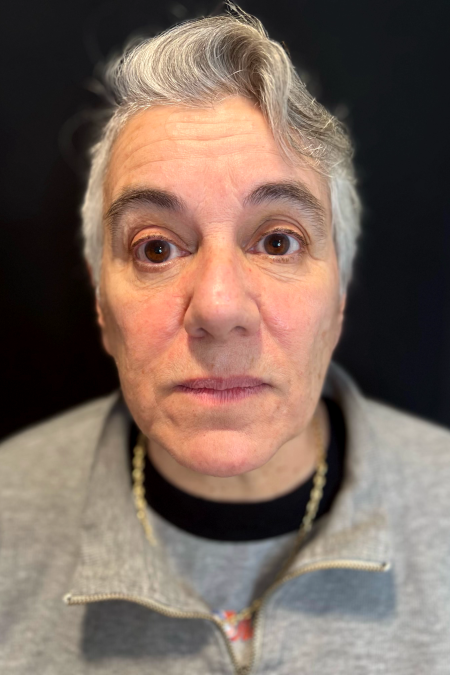 Before image 1 Case #127521 - Neck Lift